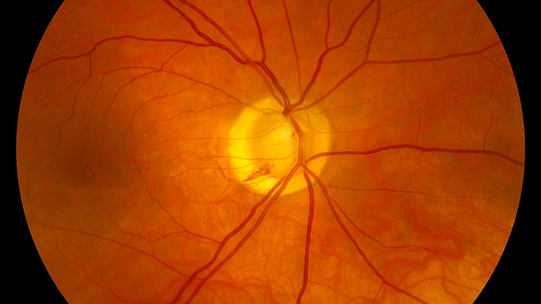 Optic Nerve Atrophy
